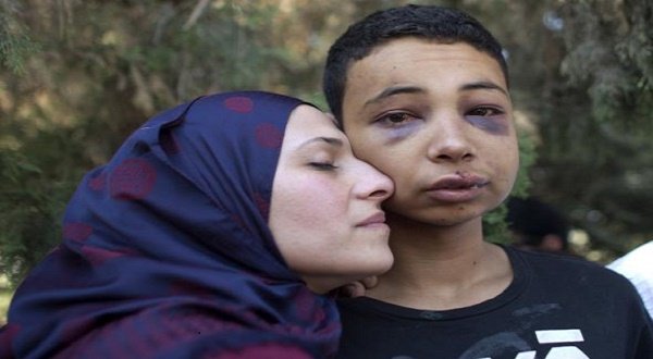 Palestinian American teenager Tariq Abu Khdeir who was brutally beaten up and tortured by Israeli Police with his mother after his release. 